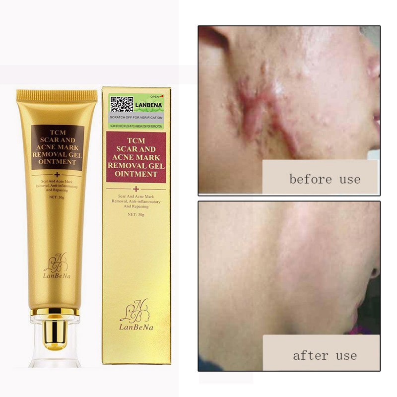 to remove burn marks on skin cream